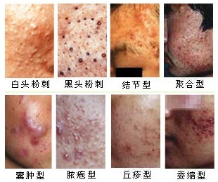 青春痘 青春痘治疗    痤疮(pimple)是美容皮肤科的最常见的病种之一